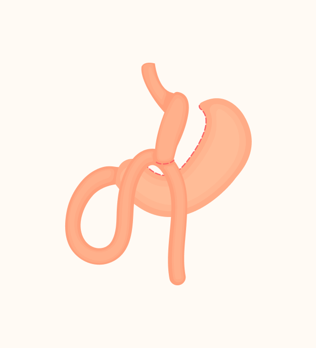 Img mini gastric bypass