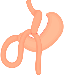 Icn Minigastricbypass