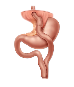Roux en-y Gastric Bypass