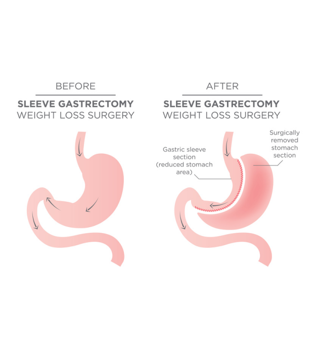 sleeve gastrectomy